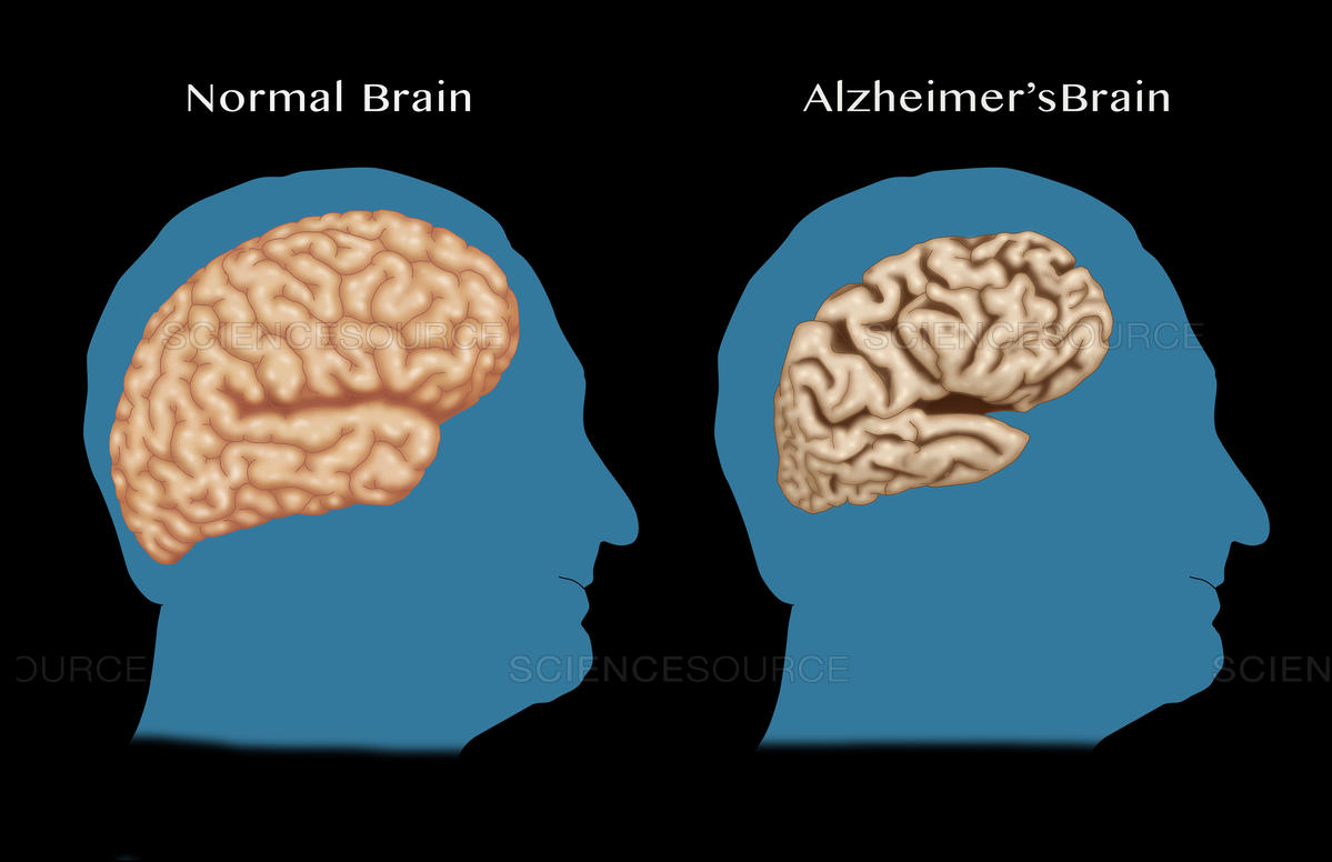 Healthy brain vs Alzheimer's Brain